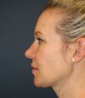Feel Beautiful - Nose Surgery 228 - After Photo